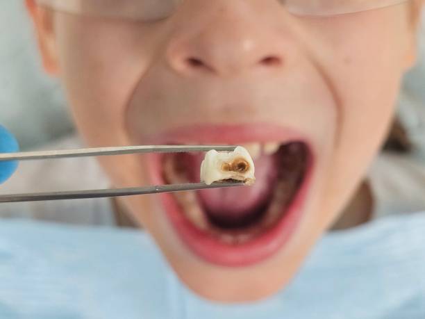 Best Emergency Dental Care for Broken or Chipped Teeth in Coopertown, TN